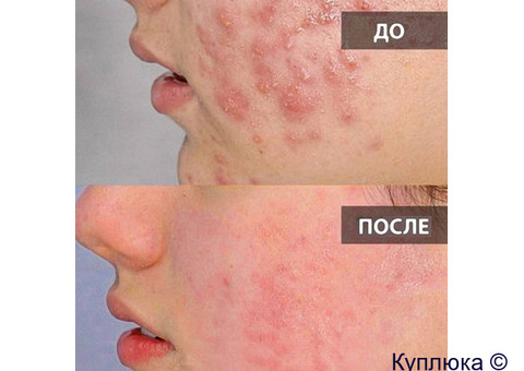 Катушки Мишина с генератором